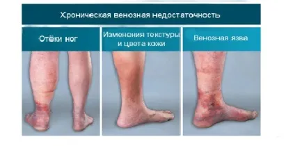 Лімфовенозна недостатність - стадії і лікування хвороби (лікування) Лімфовенозна недостатність - стадії і лікування хвороби