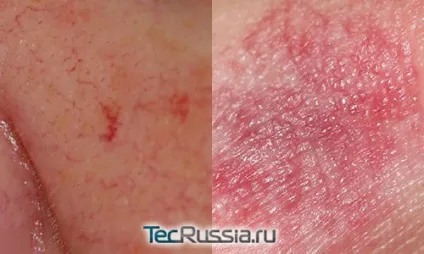 Лопнула судина на обличчі - що робити, як прибрати фото, причини появи і лікування пошкоджених
