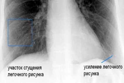 Легені курця і здорової людини фото для порівняння (курця) Легені курця і здорової людини фото для порівняння