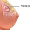 Дисплазія молочної залози що таке - доброякісна дисгормональная дисплазія (залози) Дисплазія молочної залози що таке - доброякісна дисгормональная дисплазія