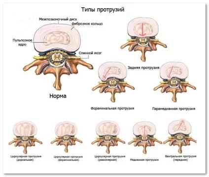 Дорзальная грижа диска що це таке, симптоми, лікування (диска) Дорзальная грижа диска що це таке, симптоми, лікування