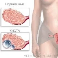 Двокамерна кіста яєчника, причина освіти