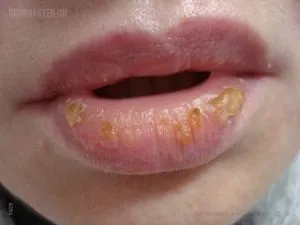 Ексфоліативний хейліт (ексудативний і суха форма) - симптоми з фото, лікування, профілактика (форма) Ексфоліативний хейліт (ексудативний і суха форма) - симптоми з фото, лікування, профілактика