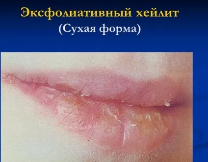 Ексфоліативний хейліт (ексудативний і суха форма) - симптоми з фото, лікування, профілактика (ексудативний) Ексфоліативний хейліт (ексудативний і суха форма) - симптоми з фото, лікування, профілактика