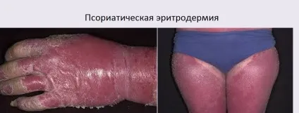 Еритродермія псориатическая личение і симптоми (симптоми) Еритродермія псориатическая личение і симптоми
