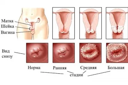 Ерозія шийки матки - причини, симптоми і лікування (симптоми) Ерозія шийки матки - причини, симптоми і лікування