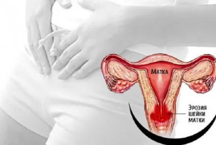 Ерозія шийки матки - причини, симптоми і лікування (симптоми) Ерозія шийки матки - причини, симптоми і лікування