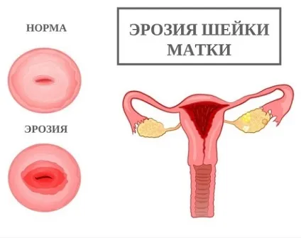 Ерозія шийки матки - причини, симптоми і лікування (шийки) Ерозія шийки матки - причини, симптоми і лікування