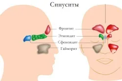 Гнійний синусит і його лікування