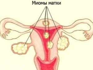 Гомеопатія при міомі матки (міоми Гомеопатія міомі) Гомеопатія при міомі матки