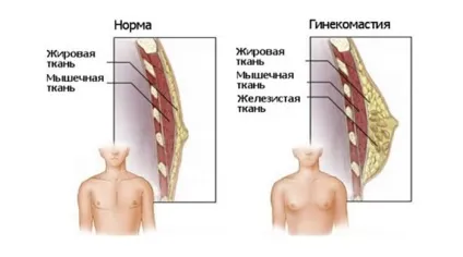 Гінекомастія у чоловіків ціна лікування, ризики розвитку, обстеження (гінекомастія) Гінекомастія у чоловіків ціна лікування, ризики розвитку, обстеження