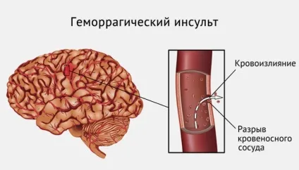 Геморагічний інсульт мозку причини і наслідки (наслідки) Геморагічний інсульт мозку причини і наслідки
