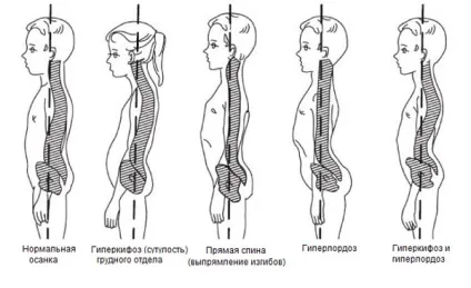 Гіперкіфоз грудного відділу хребта симптоми, ступеня і лікування (гіперкіфоз) Гіперкіфоз грудного відділу хребта симптоми, ступеня і лікування