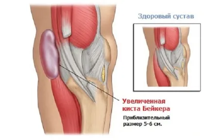 Гігрома під коліном медикаментозне лікування і операція (операція) Гігрома під коліном медикаментозне лікування і операція