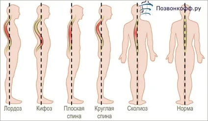Викривлення хребта у дітей лікування, симптоми і наслідки від немовляти до підлітка (дітей) Викривлення хребта у дітей лікування, симптоми і наслідки від немовляти до підлітка