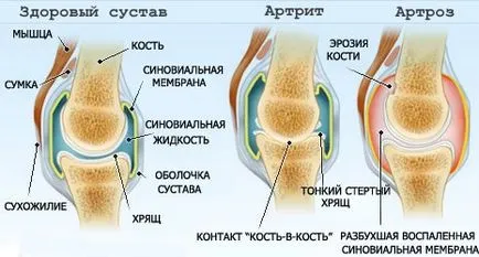 Как предотвратяване на артрит