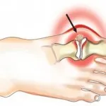 Как да премахнете болката от подагра