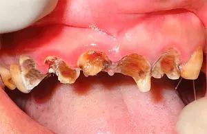 Fogszuvasodás, mint veszélyes, ha nem kezelik, ha nem kell, hogy fáj, hogy hogyan befolyásolja a szervezet