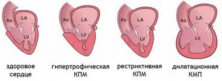 Cardiomyopathy halál, mely esetekben lehetséges következményei