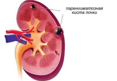 vese ciszta tünetek a nők és a kezelés, mint a veszélyes