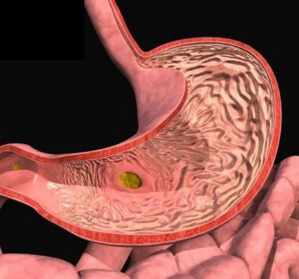 Intestinalis metaplázia a gyomornyálkahártya okok és a kezelés