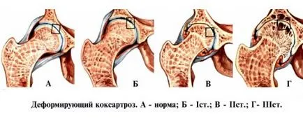 хип коксартроза степен 3 лечение без операция