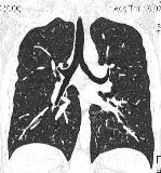 A komputertomográfia (CT), a mellkas (mediastinum) a Permi