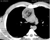 A komputertomográfia (CT), a mellkas (mediastinum) a Permi