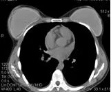 A komputertomográfia (CT), a mellkas (mediastinum) a Permi