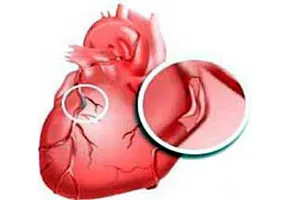 Boala coronariana (GLC, KBS) patogeneza, simptome, tratament, prognostic, simptome, diagnostic