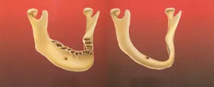 Остеопластика челюсти със зъби в часовник зъбни импланти стоматология в Москва