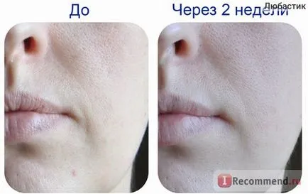 Вдигане крем кора за корекция на бръчки по лицето и възраст - 