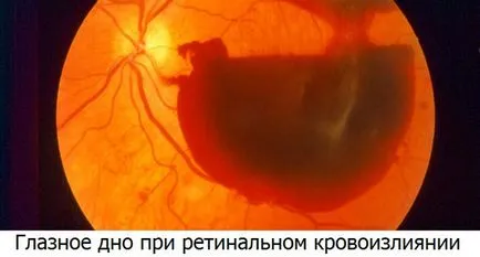 Кръвоизлив на ретината - причини, симптоми и ефективно лечение