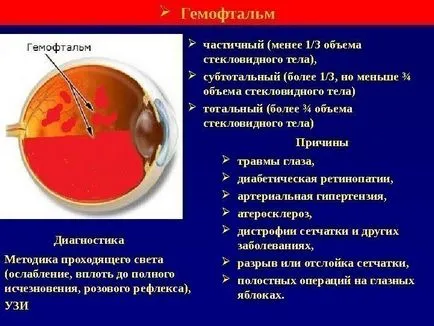 Üvegtesti vérzés szeme - okai, tünetei és kezelése