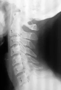 Tratamentul hernia spinării a remediilor populare coloanei cervicale