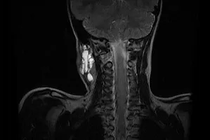 Lymphangioma на врата при деца, лекувани и снимки