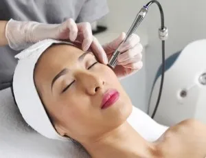 resurfacing cu laser postacne - atunci când se poate face