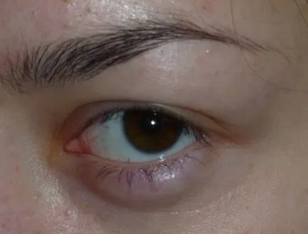 Tratamentul episclerită ochii cu remedii populare