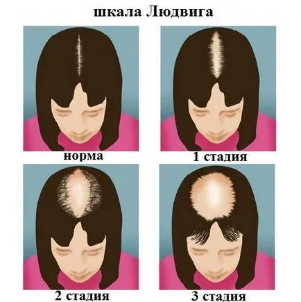 Tratamentul alopeciei androgenice la femei și bărbați, care cauzeaza pierderea parului