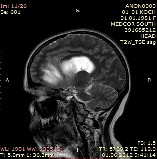 Brain tratament Lipom, fotografie, prognoza