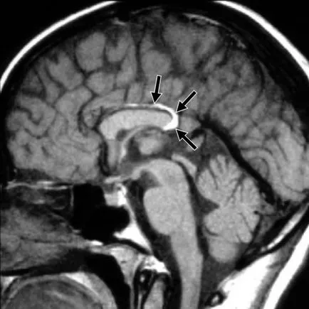 Brain Lipoma