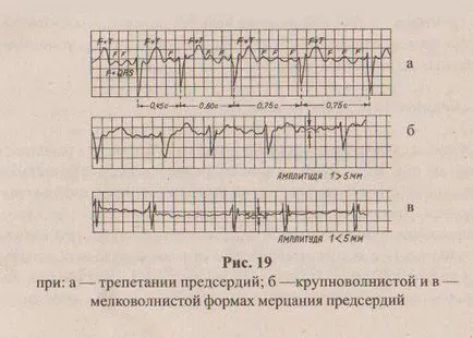 Предсърдното мъждене, симптомите на предсърдно мъждене в ЕКГ