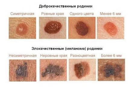 Възможно ли е да се премахнат бенки по лицето видове образование, методи на забрани за депониране