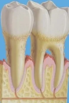 Denudare și inflamație a rădăcinii dintelui și a canalului radicular tratament