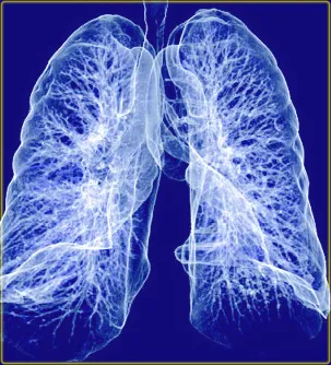 Ompyuternaya томография (КТ) за сканиране на белите дробове и медиастинални