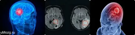 Мозъчен тумор причини, класификация, диагноза