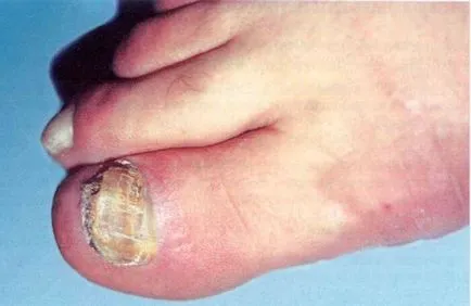 Onychomycosis köröm kezelés otthon 1