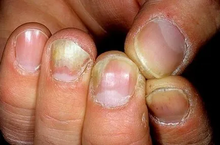 Onychomycosis лечение на ноктите у дома 1