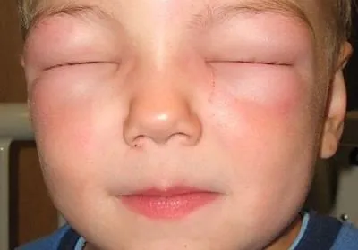 Angioedema gyermekeknél a tünetek, okok, elsősegély