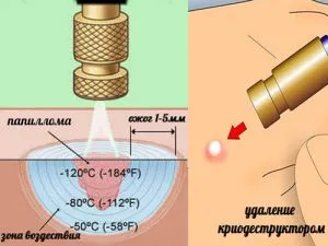 Папиломен на краката начини за обезвреждане и снимки